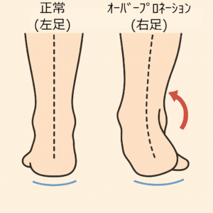 正常とｵｰﾊﾞｰﾌﾟﾛﾈｰｼｮﾝの比較イラスト